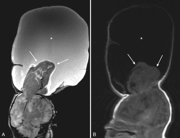 Figure 8.26, Cephalocele.