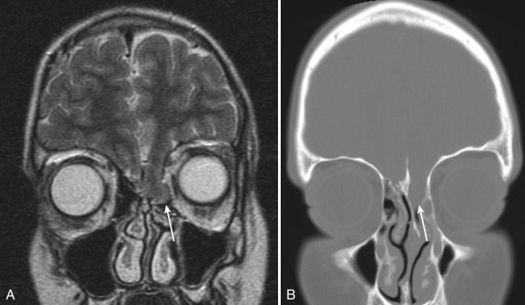 Figure 8.27, Ethmoidal encephalocele.