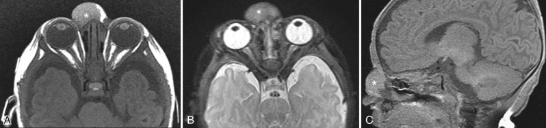 Figure 8.28, Nasal glioma.