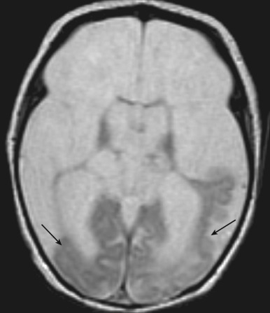 Figure 8.29, Hydranencephaly.