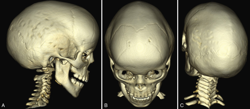 Figure 8.30, Sagittal synostosis.