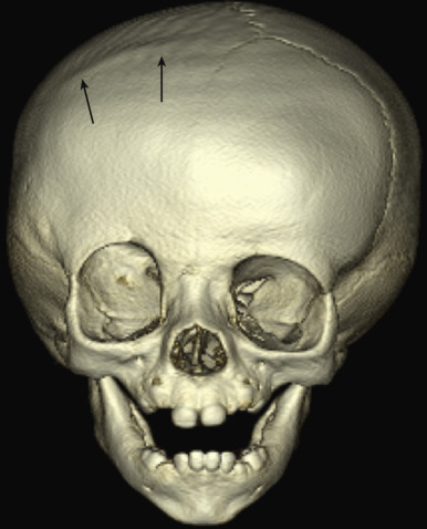 Figure 8.31, Unicoronal synostosis.