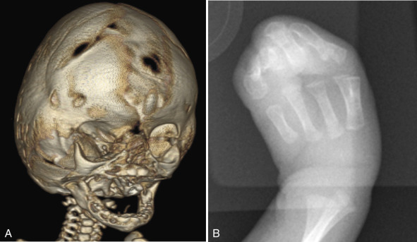 Figure 8.32, Apert syndrome.