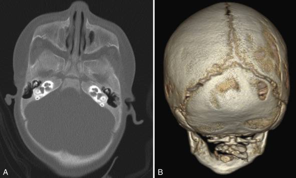 Figure 8.33, Positional plagiocephaly.