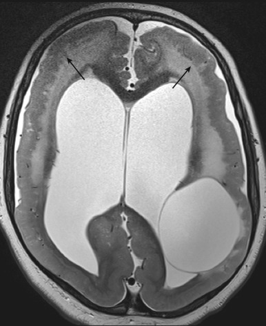 Figure 8.4, Type 2 (cobblestone) lissencephaly. Ten-year-old boy. Axial T2-weighted magnetic resonance imaging shows diffuse cobblestone appearance of the cortex with irregular inner cortical margin ( arrows ), ventriculomegaly, and left parietotemporal cyst.