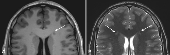 Figure 8.5, Gray matter heterotopia.