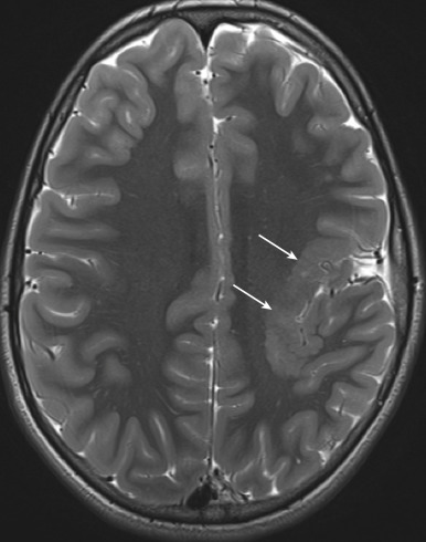 Figure 8.6, Peri-Sylvian polymicrogyria.