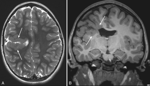 Figure 8.7, Schizencephaly.