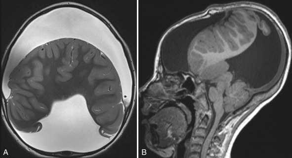 Figure 8.8, Alobar holoprosencephaly.