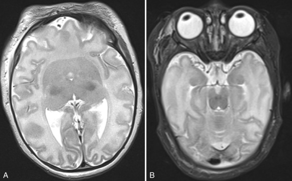 Figure 8.9, Semilobar holoprosencephaly.