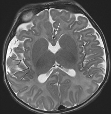 Figure 8.10, Lobar holoprosencephaly.