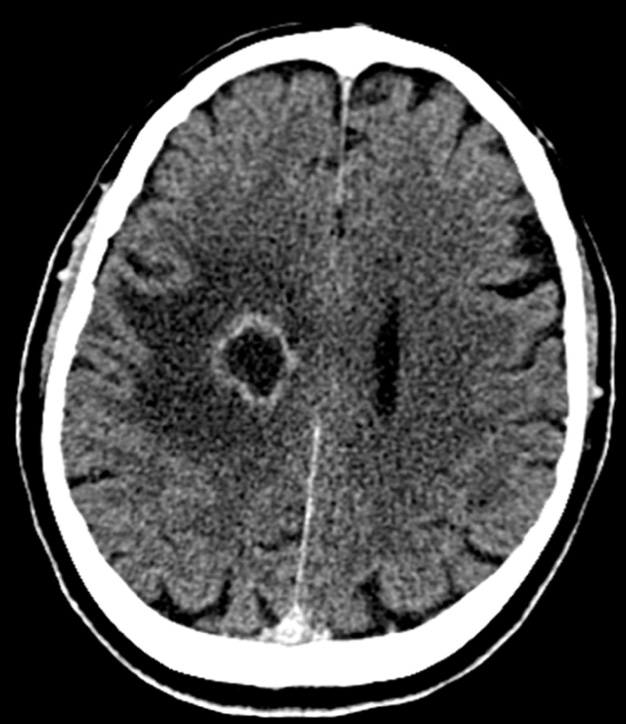 Cerebral abscess. CT: low attenuation central abscess cavity surrounded by an enhancing rim and white matter vasogenic oedema. The medial aspect of the enhancing rim is subtly thinned. *
