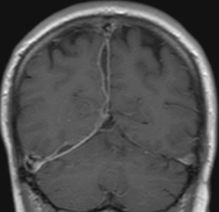Subdural empyema. Coronal T1WI + Gad shows the empyema is loculated and also extends along the right tentorial leaflet. *