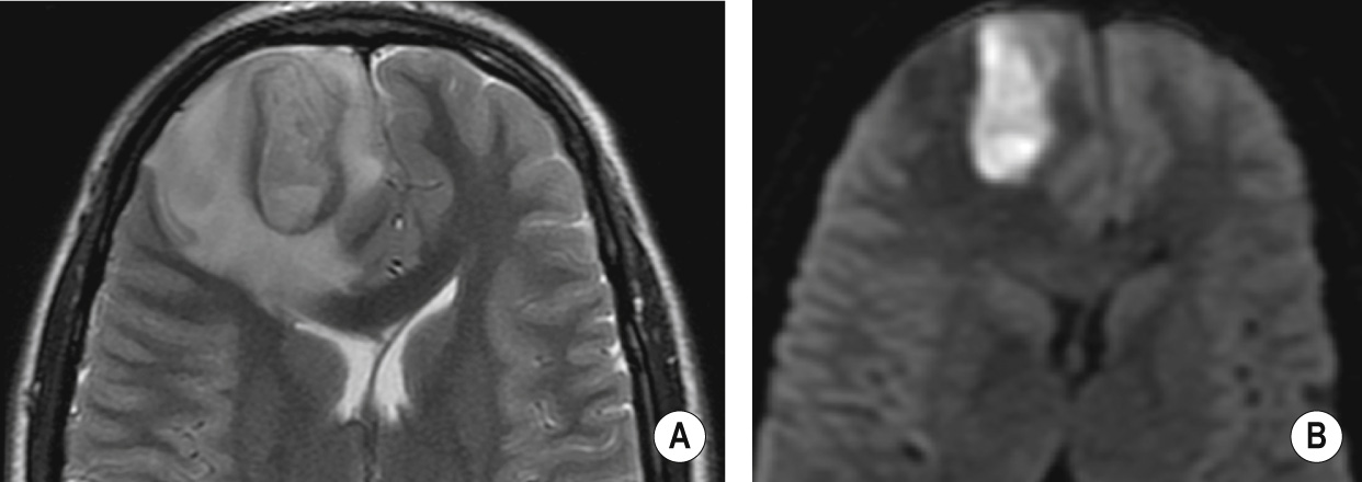 Streptococcal abscess due to penetrating trauma. (A) Axial T2WI. Note low signal of the abscess capsule and extensive high signal perilesional oedema. (B) DWI shows high signal in the abscess centre, indicating restricted diffusion. *