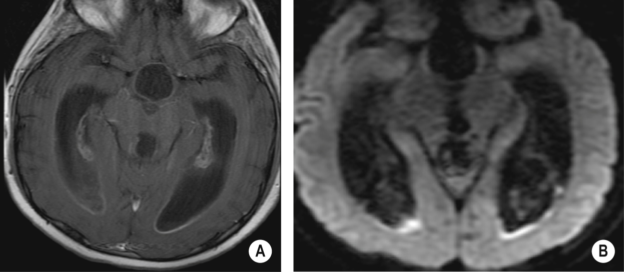 Ventriculitis. (A) Subependymal enhancement, most marked posteriorly, extends along the margins of the dilated ventricles. (B) DWI shows restricted diffusion as high SI. *