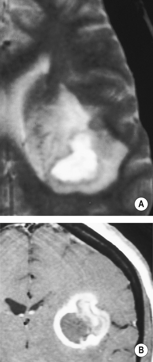 Fungal abscess. (A) Axial T2WI. Central high SI abscess cavity with surrounding vasogenic oedema. (B) Coronal T1WI + Gad. Large multiloculated abscess cavity with enhancement of the capsule and abscess wall. Note relative thinness of the medial wall compared with the thicker, more irregular, lateral component. *