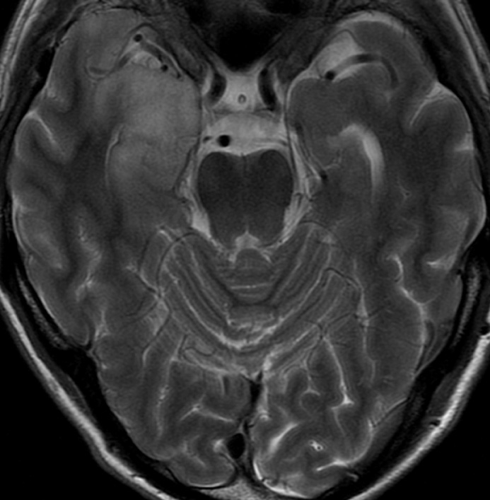 Herpes simplex encephalitis. Axial T2WI shows swelling and high SI in the anteromedial right temporal lobe with normal appearance on the left. *