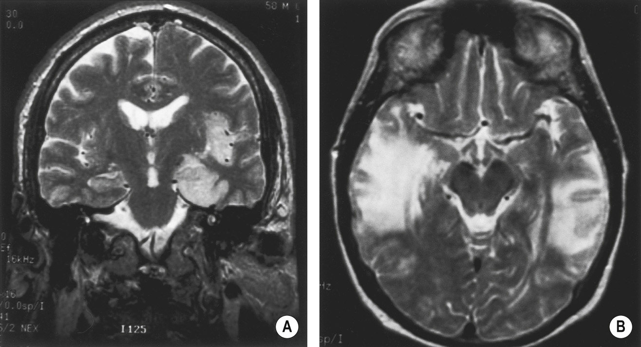 (A) Herpes encephalitis. Coronal T2WI shows swelling of the left temporal lobe with sparing of the basal ganglia. (B) T2WI demonstrating bilateral disease. *