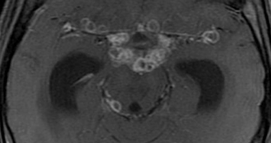 Tuberculous meningitis. T1WI + Gad shows basilar meningeal enhancement, and multiple ring-enhancing tuberculomas in the suprasellar and ambient cisterns and the medial sylvian fissures. Marked dilatation of the temporal horns indicates hydrocephalus. *