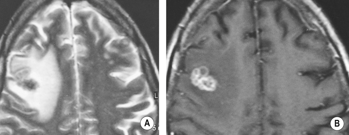 Axial T2WI image (A) showing a low SI caseating tuberculous granuloma in the right frontal lobe in association with vasogenic oedema. The lesion is situated at the grey–white matter junction and on the T1WI + Gad image (B) it has a multiloculated ring-enhancing appearance. †