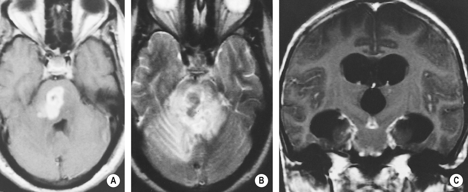 An irregular enhancing tuberculoma is shown within the pons on the postcontrast axial T1-weighted MR image. (A) The lesion is of relatively low signal on the T2 axial image (B) and there is extensive vasogenic oedema and some modest mass effect with distortion of the 4 th ventricle. On the coronal T1 postcontrast image (C) there is nodular meningeal thickening and enhancement around the brainstem and cerebellum. †