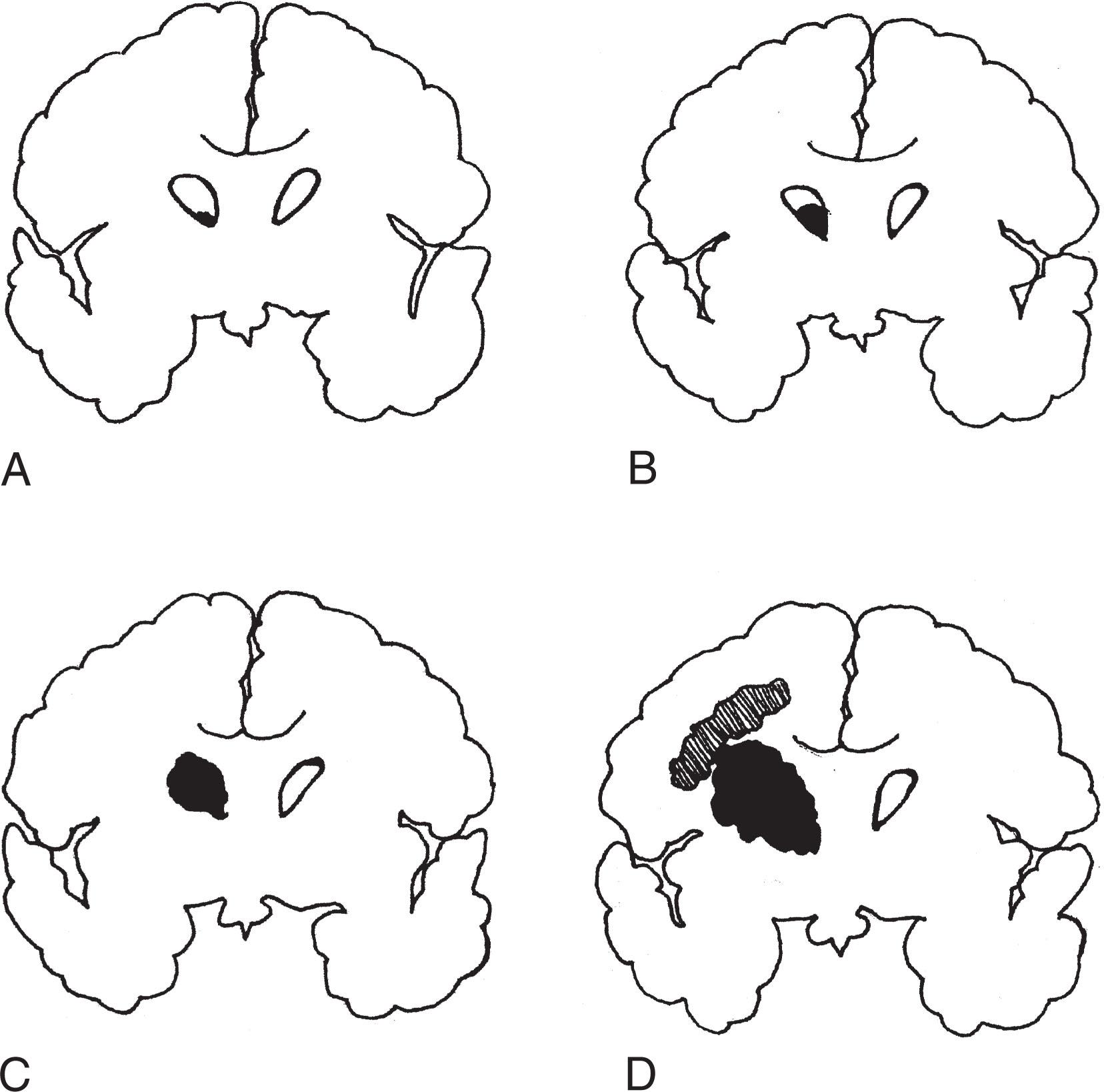 Fig. 54.1, The Progressive Grades of Intraventricular Hemorrhage from Mildest to Most Severe.