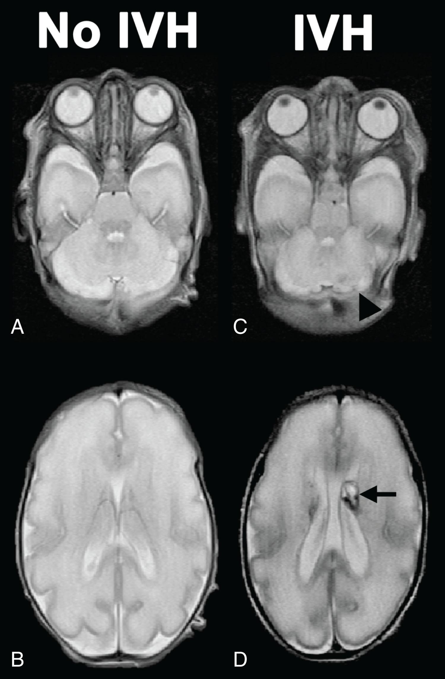 Fig. 54.2, Intraventricular Hemorrhage is Associated with Impaired Growth of the Cerebellum.