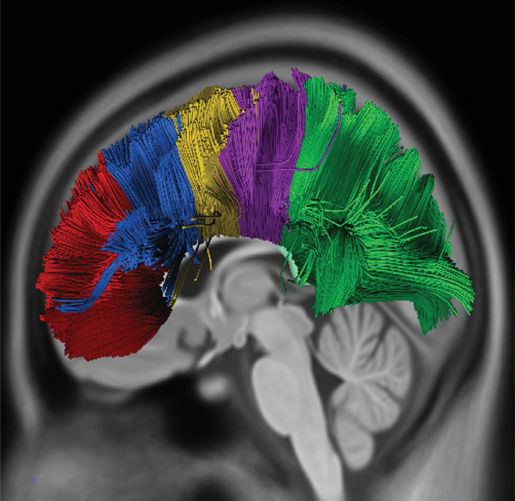 Corpus Callosum Crossing Fibers. Diffusion tensor imaging fiber tracking of anatomic segments of the corpus callosum demonstrates the following: 1) Rostrum and genu (red fibers) connect with the prefrontal and orbitofrontal cortices; 2) Anterior mid body of the corpus callosum (blue fibers) connect with the premotor and supplementary motor areas; 3) Posterior mid body of the corpus callosum (yellow fibers) connect with the primary motor areas; 4) Isthmus (purple fibers) connect with the primary sensory area; 5) Splenium (green fibers) connect with the parietal and temporal lobes and the visual cortex.