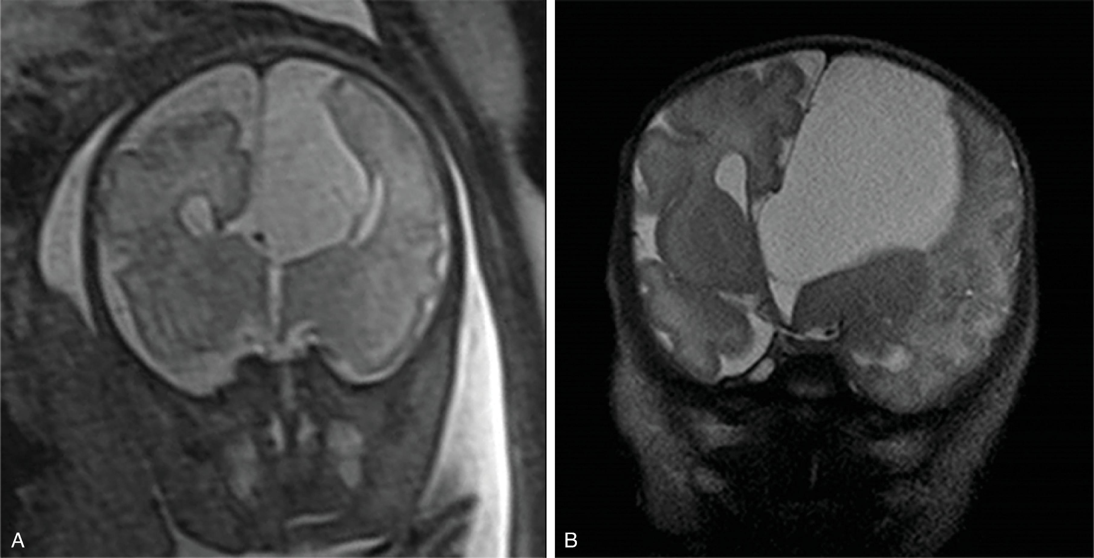 Fig. 2.11, Callosal Agenesis With Type 1 Interhemispheric Cyst .