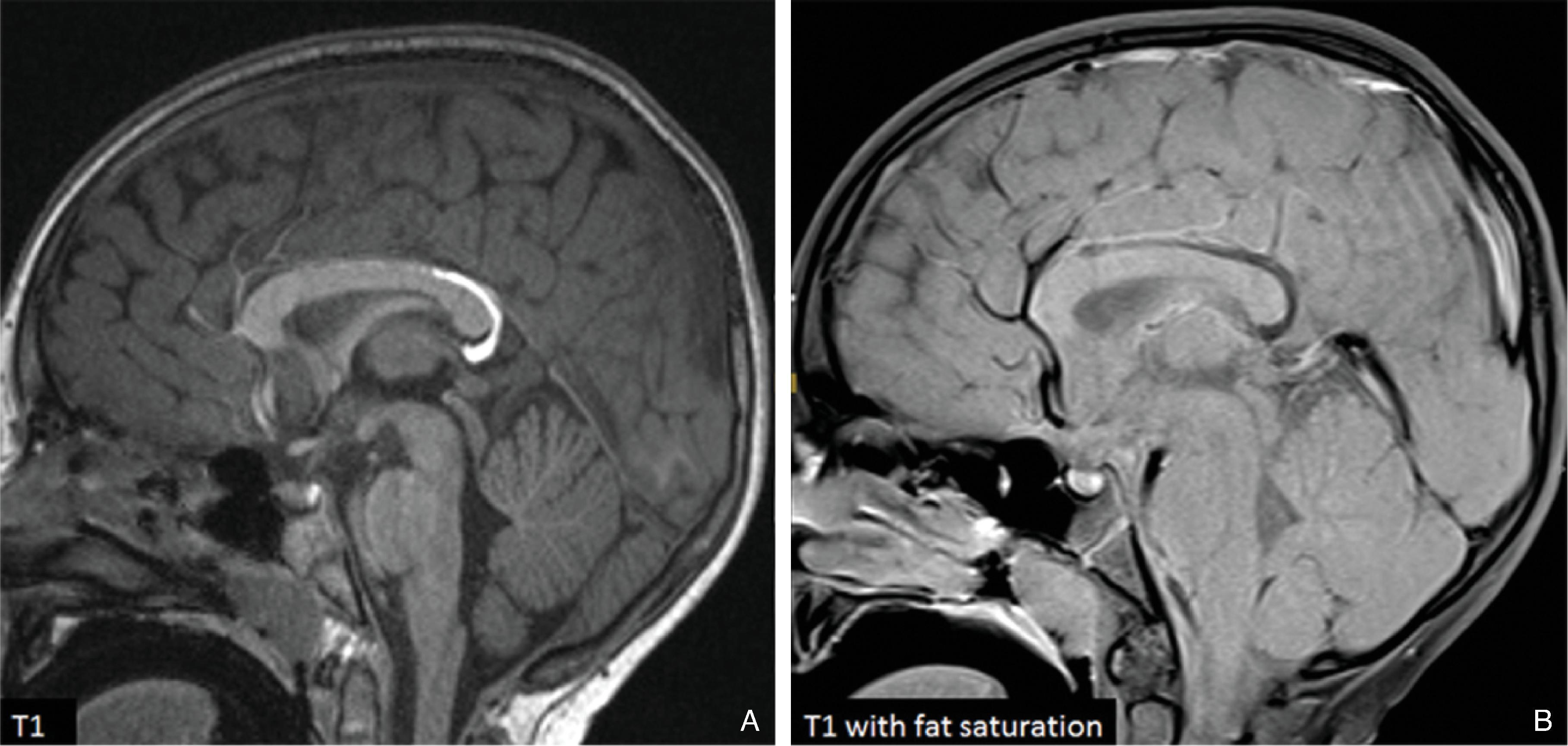 Fig. 2.13, Curvilinear Callosal Lipoma .