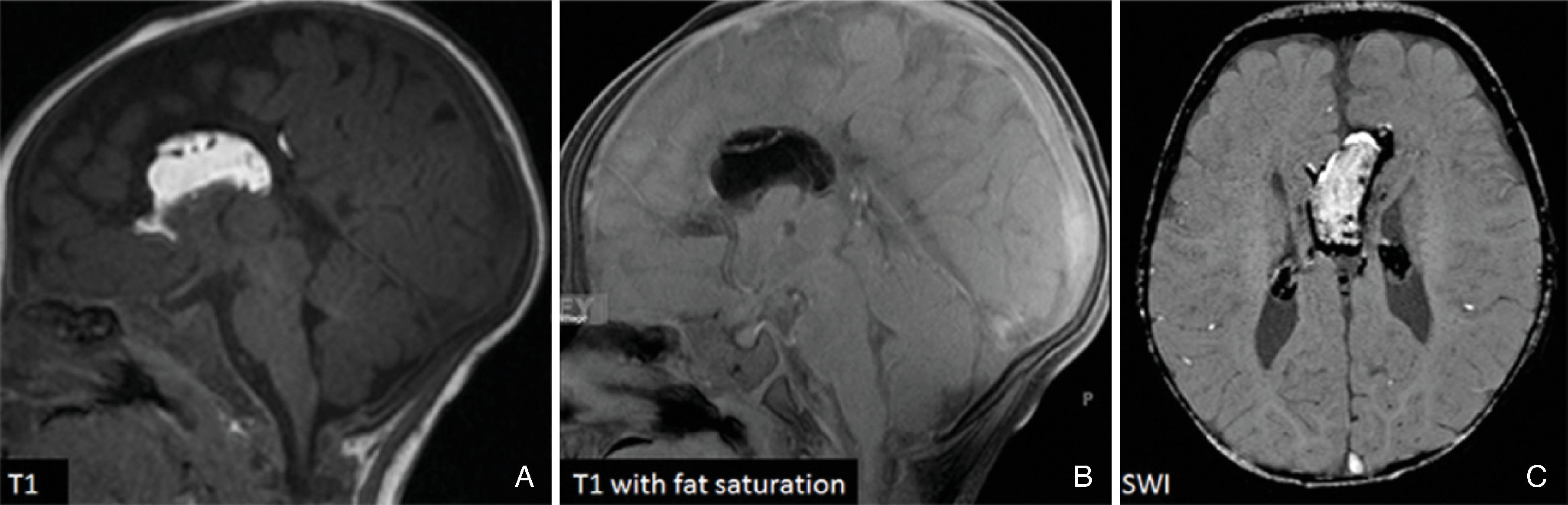 Fig. 2.14, Lobular Callosal Lipoma .