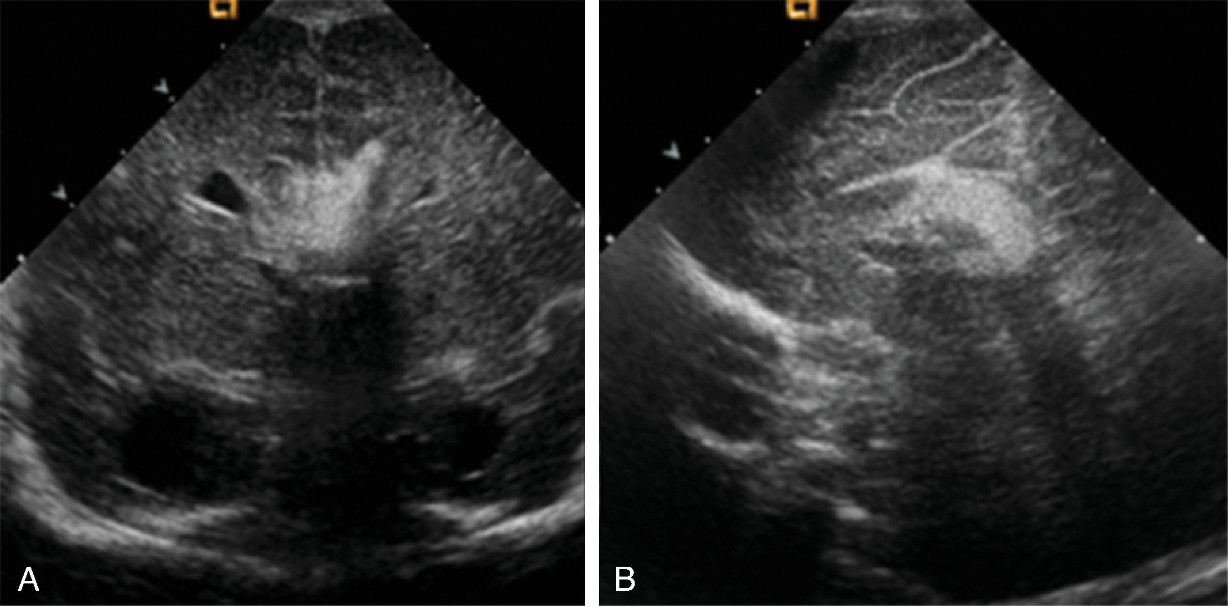 Fig. 2.15, Callosal Lipoma .