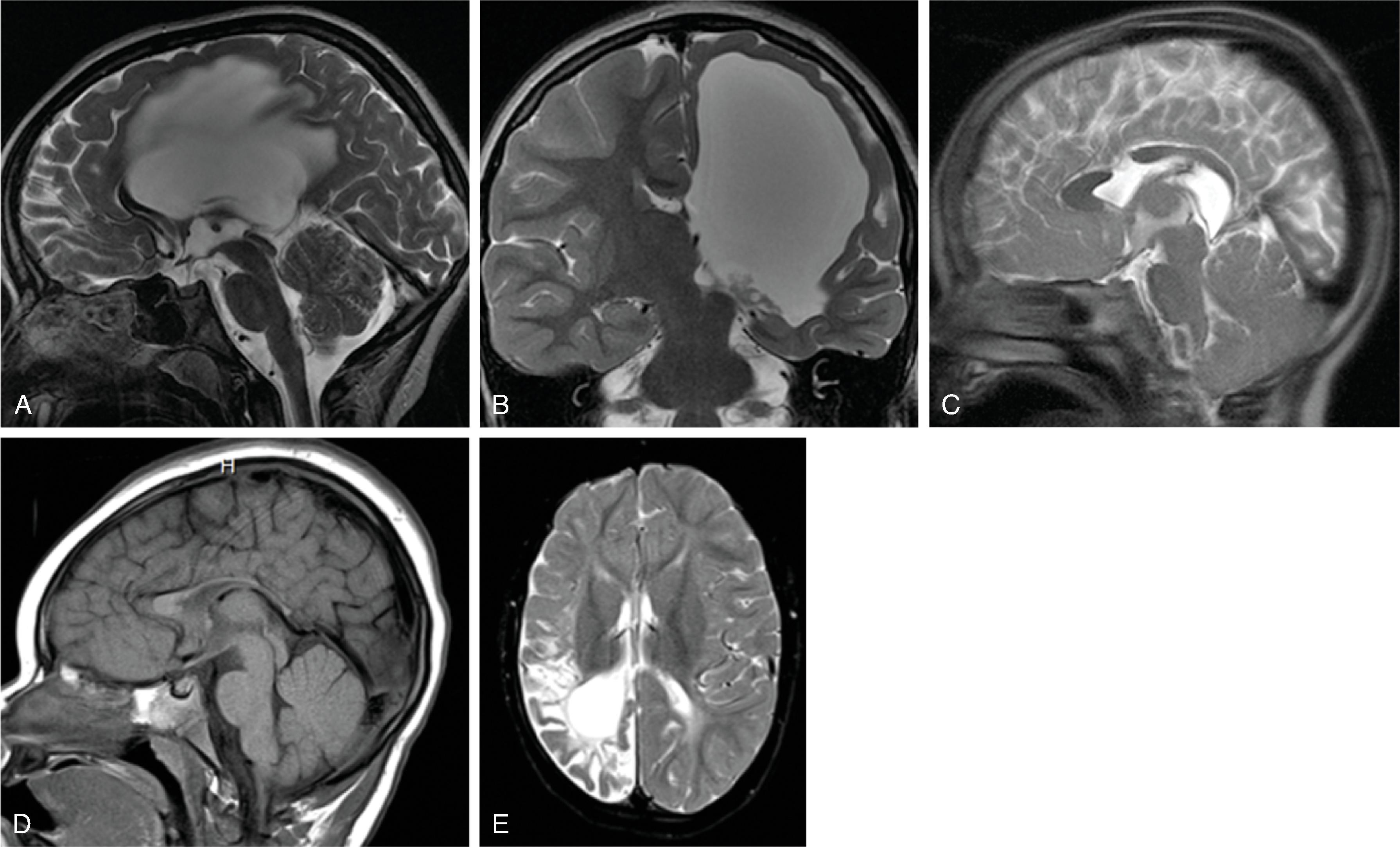 Fig. 2.17, Corpus Callosum Thinning and Defects .