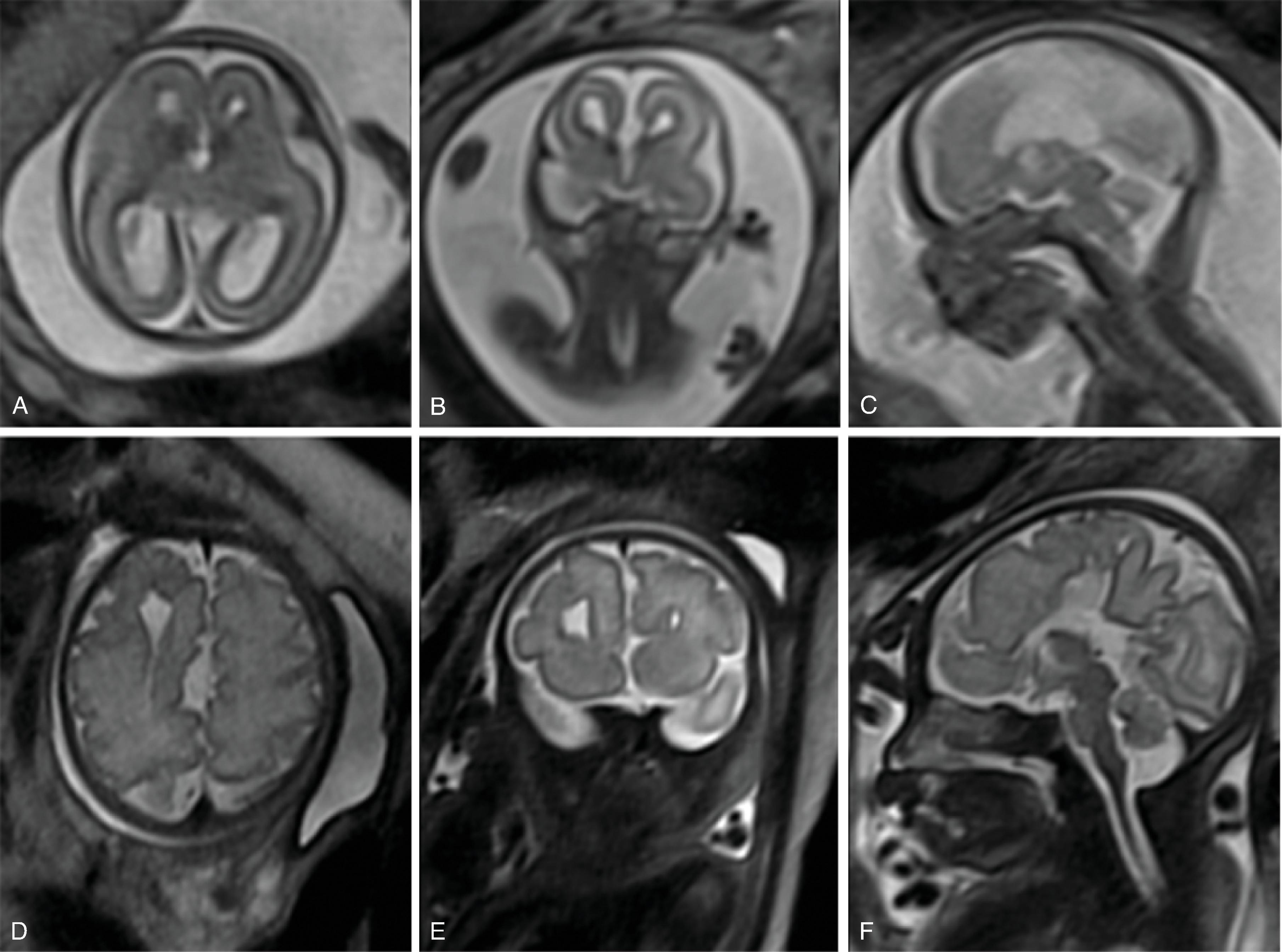 Fig. 2.18, Aicardi Syndrome .