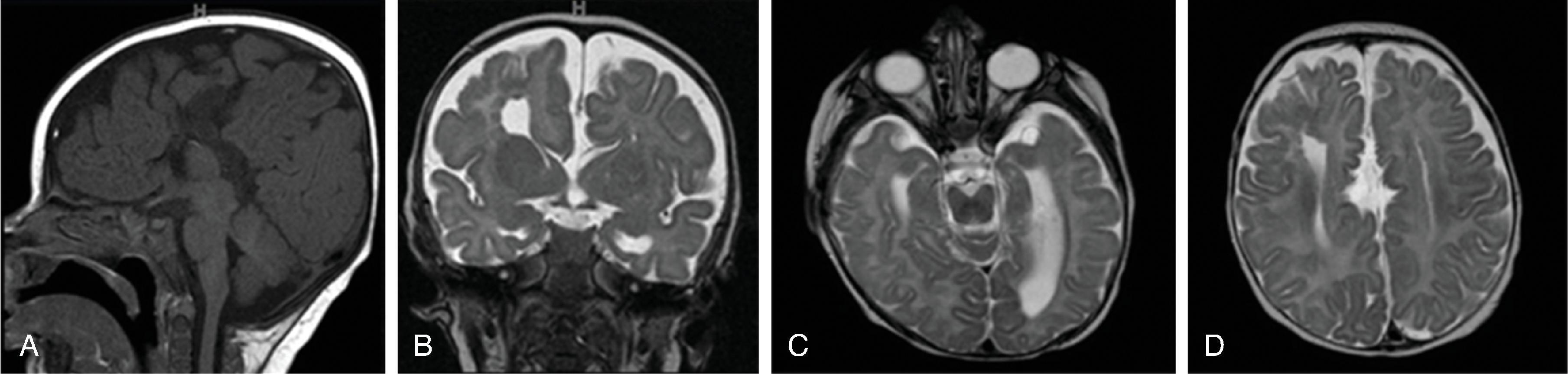 Fig. 2.19, Aicardi Syndrome .