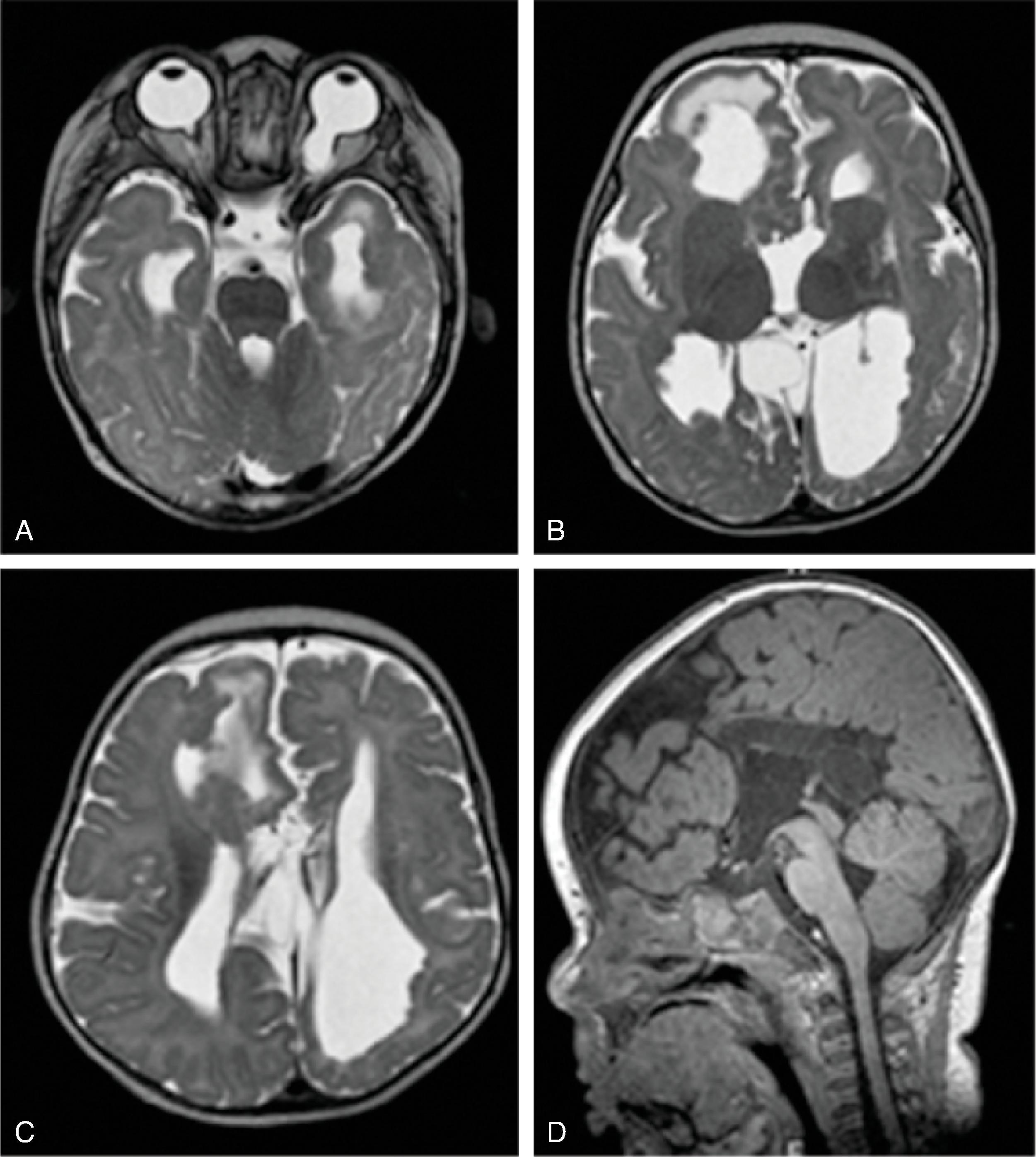 Fig. 2.20, Aicardi Syndrome .