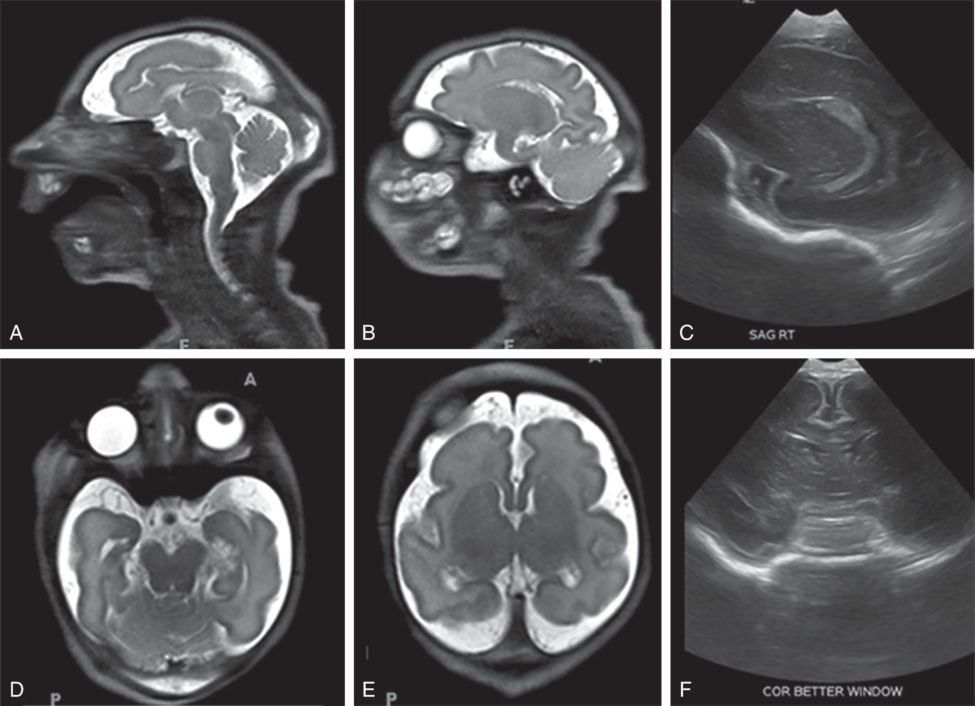 Fig. 2.22, Microcephaly With Simplified Gyral Pattern .