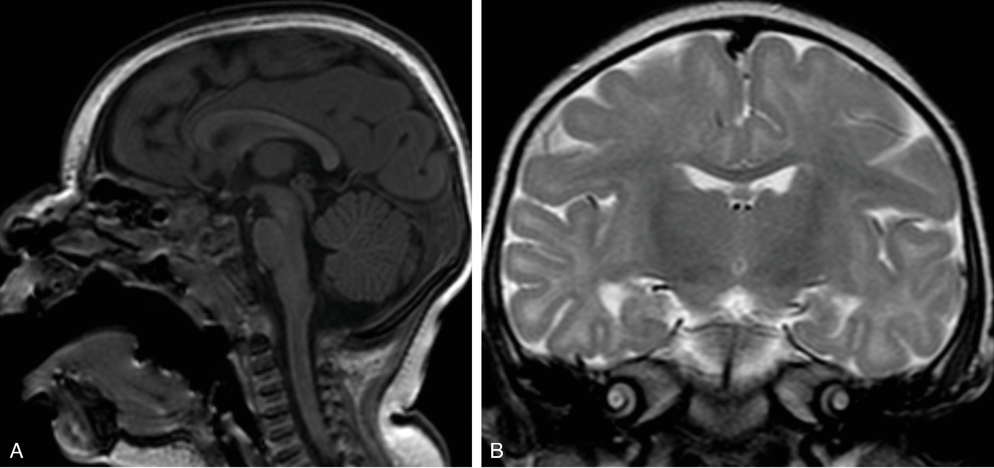 Fig. 2.23, Microcephaly Primary Hereditary .