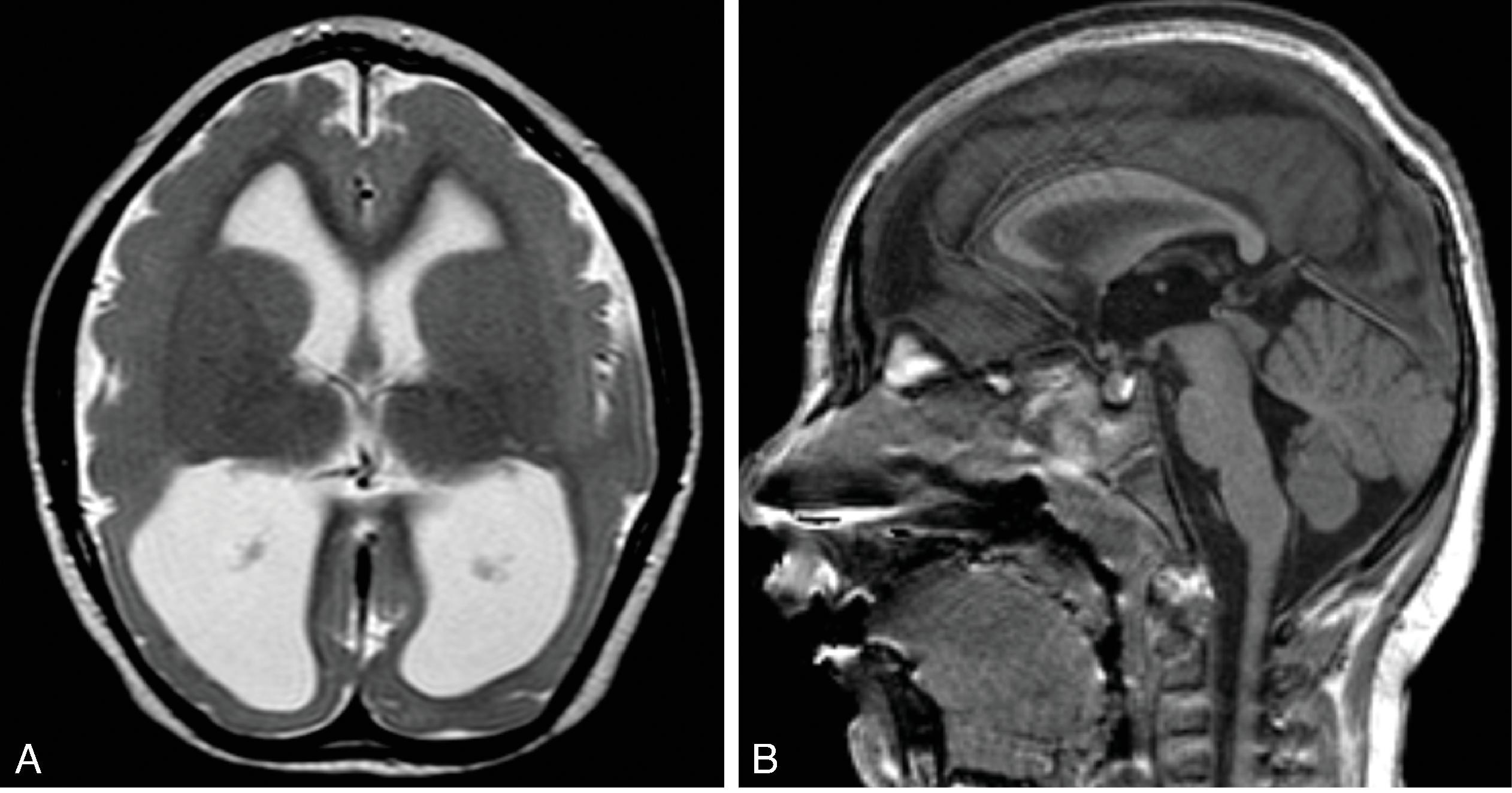 Fig. 2.24, Microcephaly With Polymicrogyria .