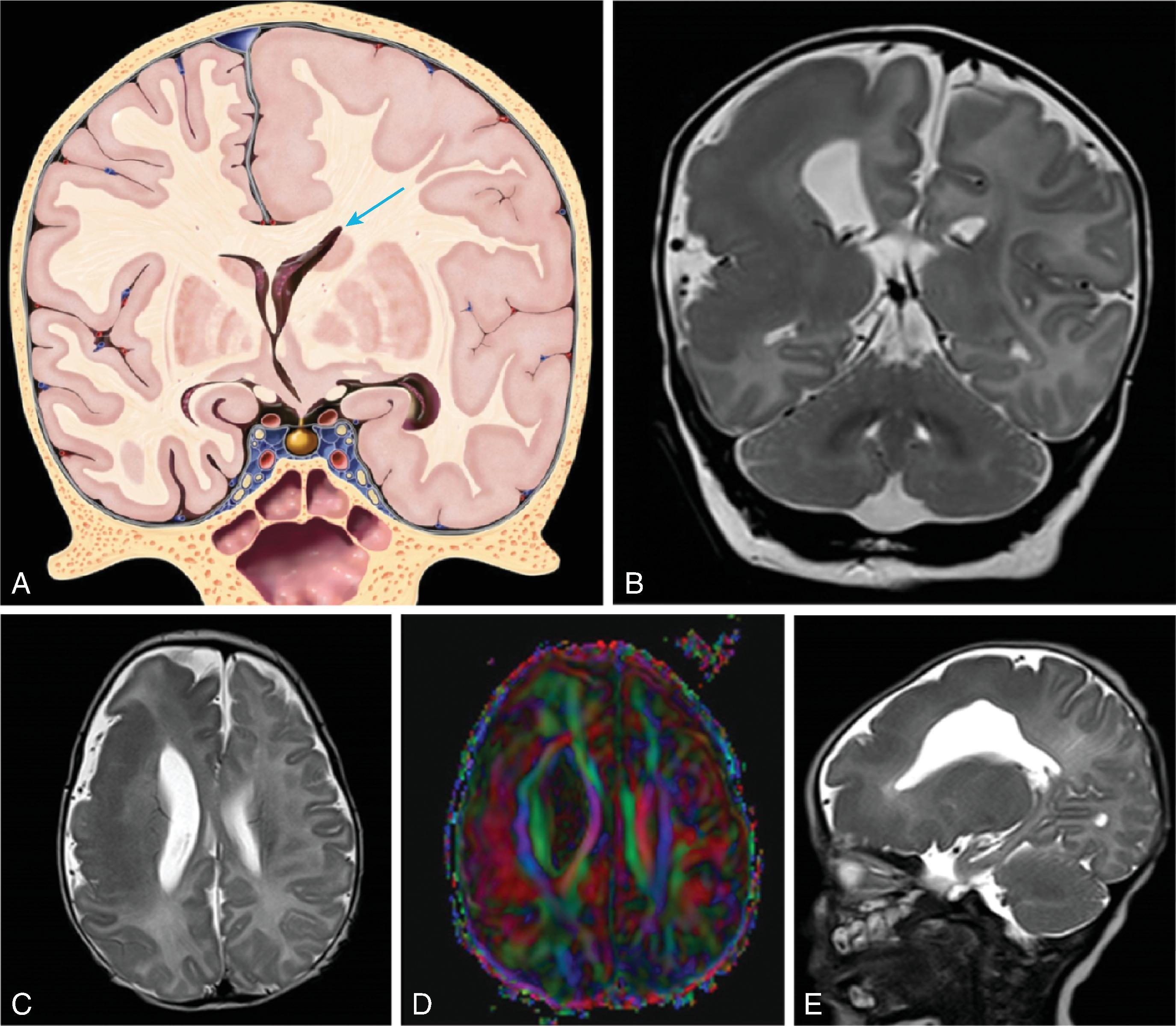 Fig. 2.26, Hemimegalencephaly .