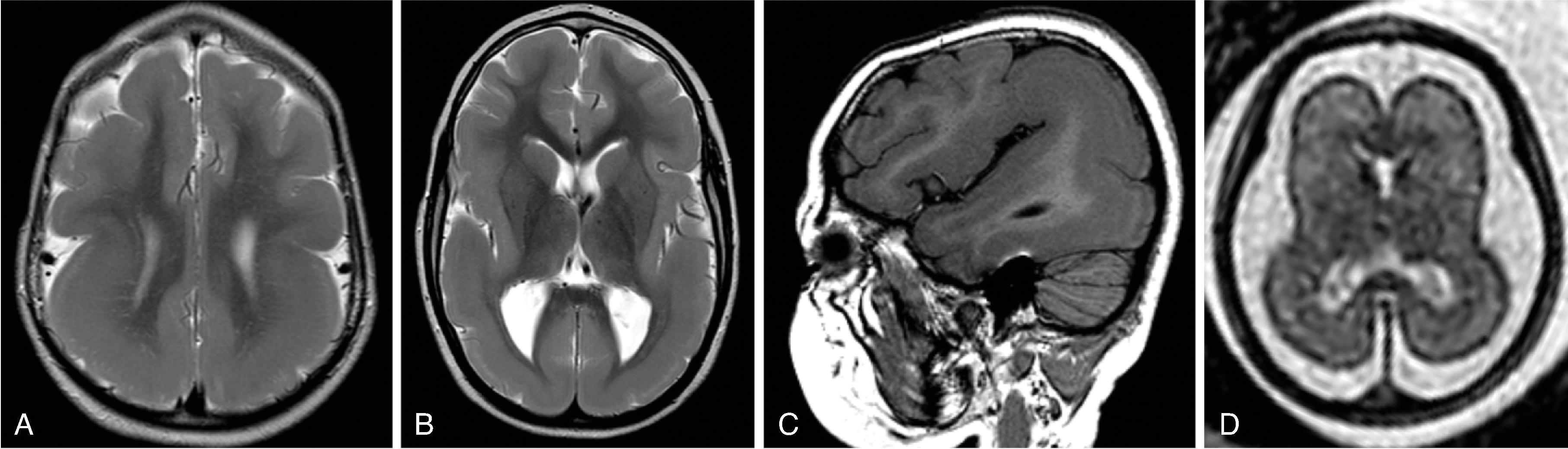 Fig. 2.27, Lissencephaly and Pachygyria due to LIS1 Mutation .