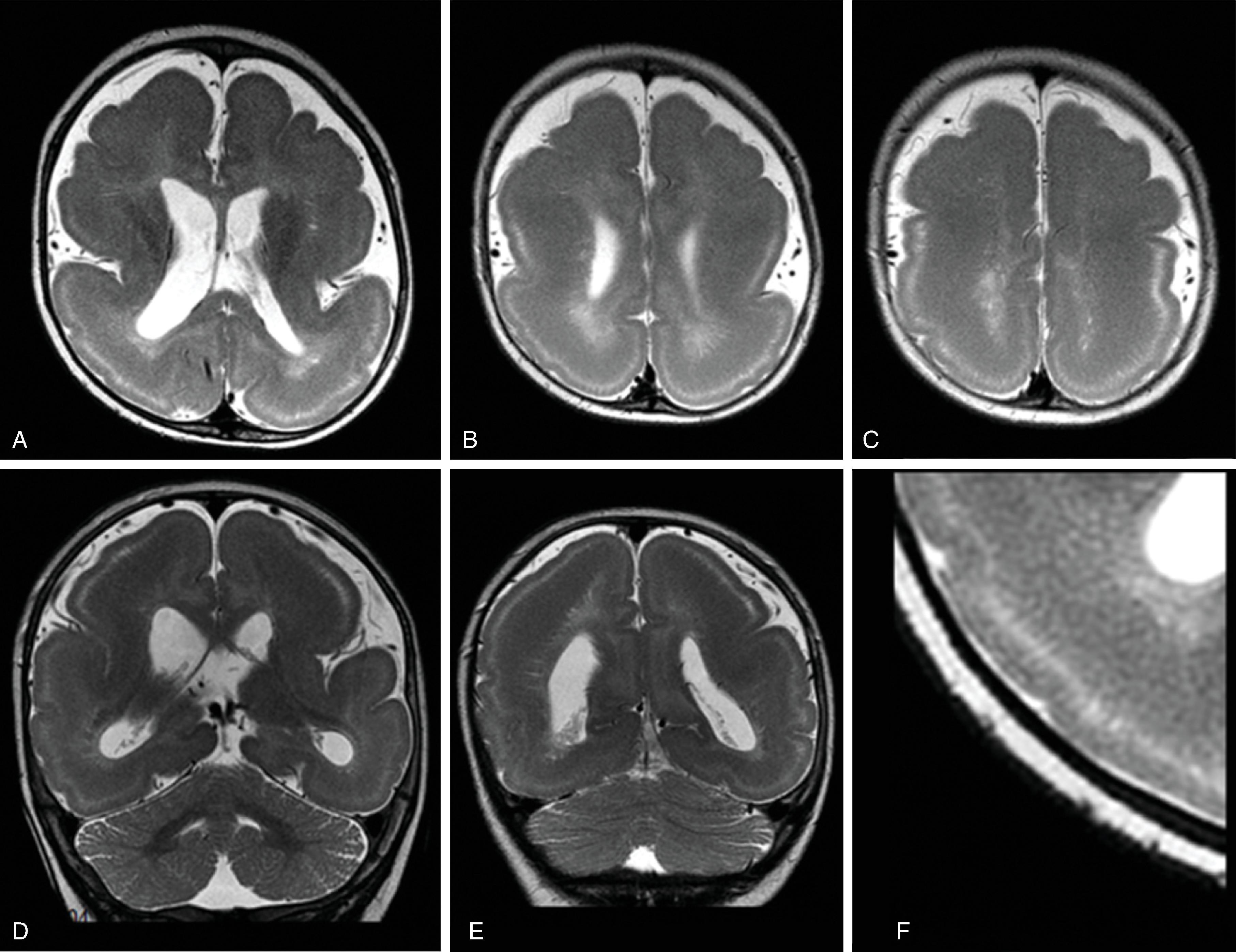 Fig. 2.28, Lissencephaly and Pachygyria due to LIS1 Mutation .