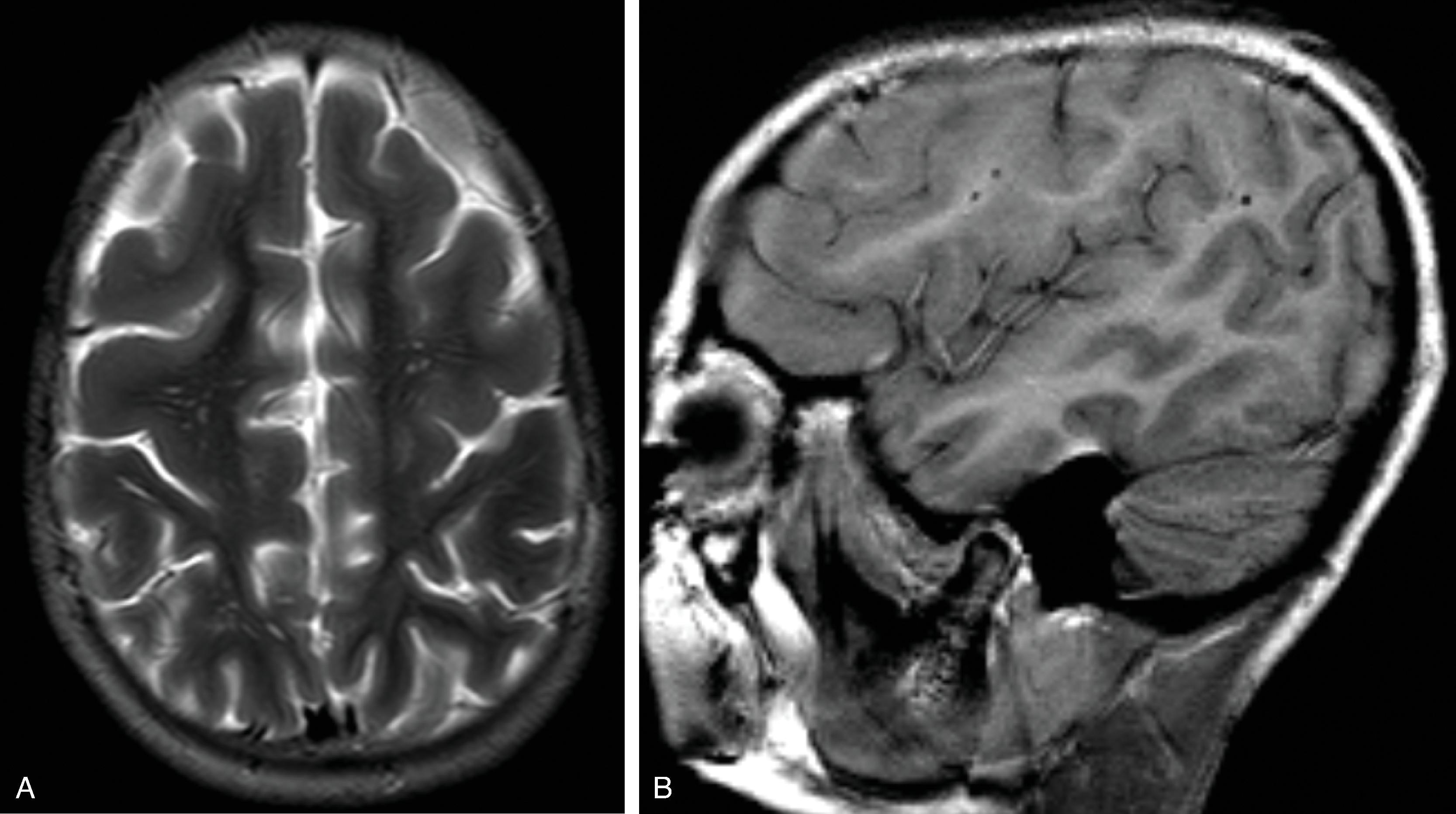 Fig. 2.29, Pachygyria From DCX Mutation .