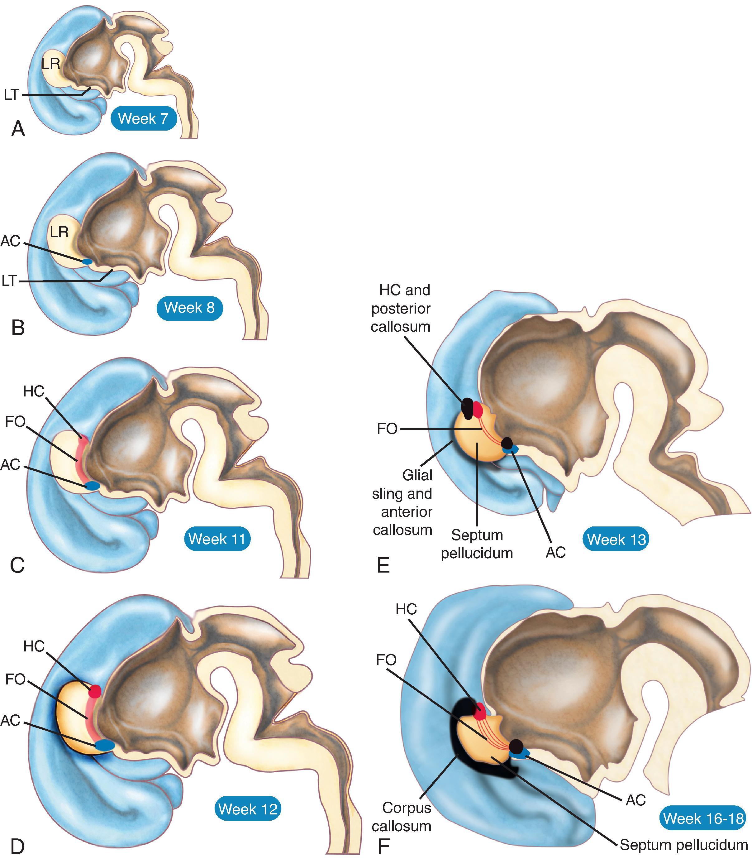 Fig. 2.2, Formation of the Corpus Callosum. (A) During week 7, the upper portion of the lamina terminalis (LT) , which connects the hemispheres across the midline, thickens and forms the lamina reuniens (LR) of His. (B) In the following week, olfactory commissural fibers cross the midline through the ventral aspect of the LR to form the anterior commissure (AC) . (C) In the following weeks, fibers develop between the anterior mediobasal cortex (septal nuclei) and the future hippocampus to form the ipsilateral fornix (FO) ; about week 11, some forniceal fibers cross the midline in the dorsal portion of the lamina reuniens and form the hippocampal commissure (HC) . (D) During week 12, the corticoseptal boundary becomes defined at the medial edge of the future neocortex, and a glial sling forms along this boundary. (E) By week 13, three commissural sites have been established: anterior commissure, hippocampal commissure, and glial sling. Depending on their origin, early neocortical commissural fibers cross the midline along the anterior commissure (temporo-occipital fibers), the glial sling (frontal fibers), or the hippocampal commissure (parieto-occipitotemporal fibers). (F) The corpus callosum enlarges by adding further commissural fibers and forms a single continuous structure stretched between the anterior commissure and the hippocampal commissure. Later, the prominent development of the frontal lobes results in posterior growth of the anterior corpus callosum, which displaces the hippocampal commissure and the splenium backward above the velum interpositum (roof above the third ventricle), stretching the body of the fornix. The corpus callosum becomes longer and thicker in development and reaches its final shape between 18 and 20 weeks’ gestation.