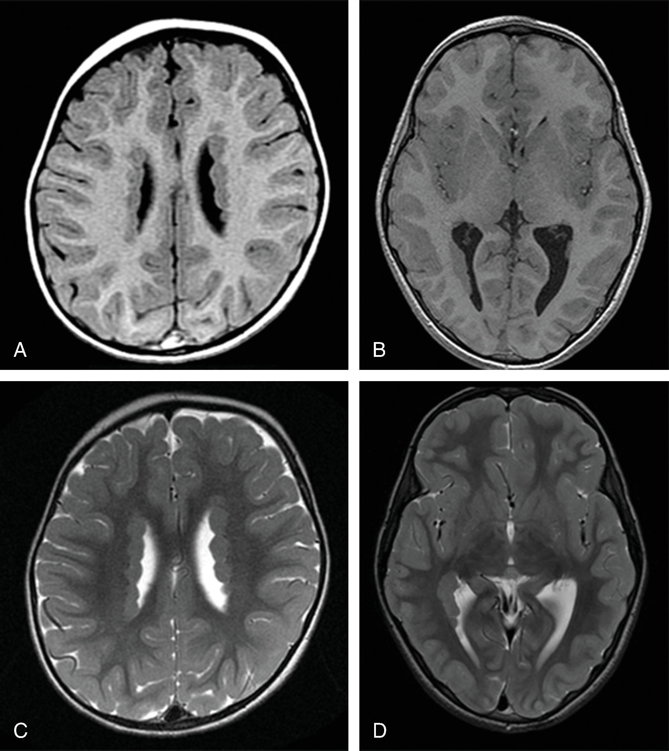 Fig. 2.31, Gray Matter Heterotopia .