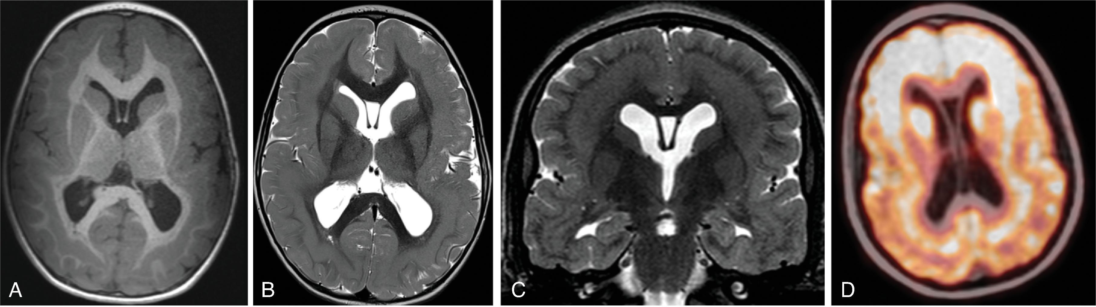 Fig. 2.33, Gray Matter Band Heterotopia in DCX Mutation .