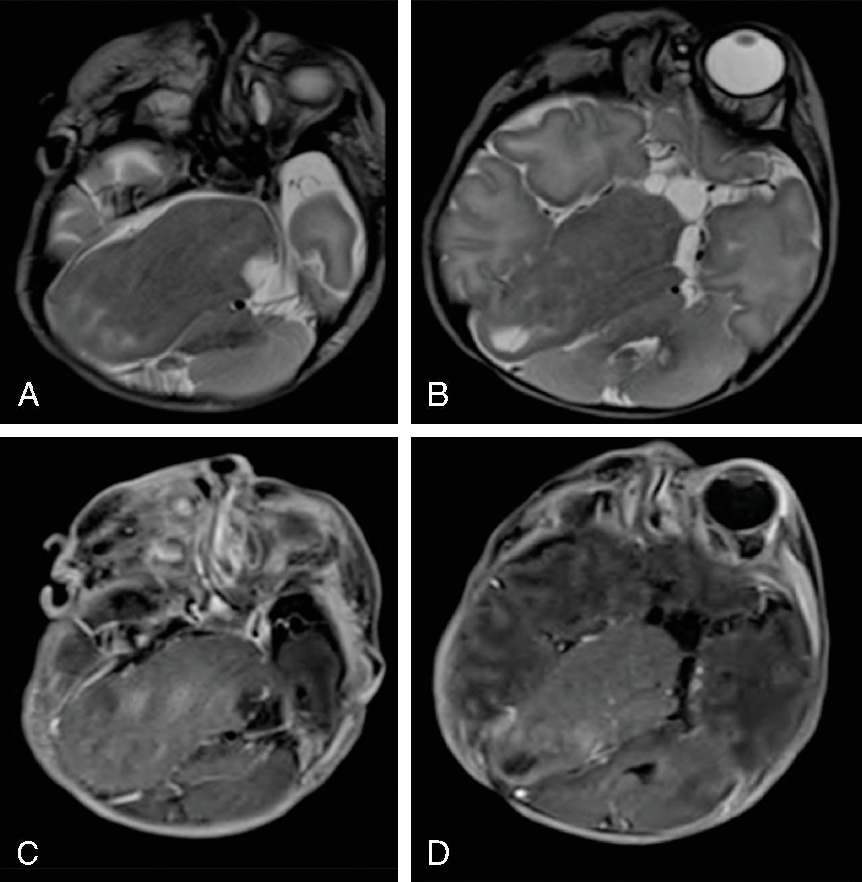 Fig. 2.35, Glioneuronal Heterotopia .