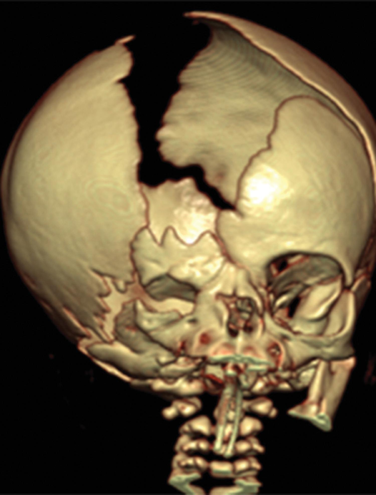 Fig. 2.36, Glioneuronal Heterotopia .