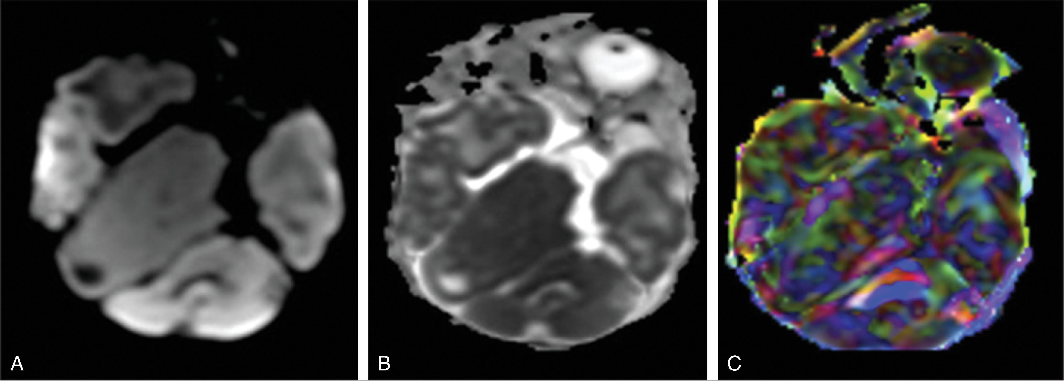 Fig. 2.37, Glioneuronal Heterotopia .