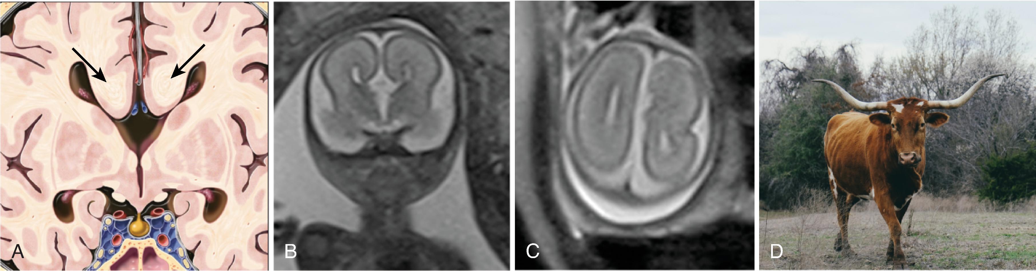 Fig. 2.3, Agenesis of the Corpus Callosum .